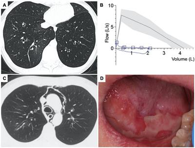 Constrictive bronchiolitis and paraneoplastic pemphigus caused by unicentric Castleman disease in a young woman: a case report